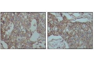 Immunohistochemical analysis of paraffin-embedded human breast carcinoma tissues, showing membrane localization with DAB staining using CD44 antibody. (CD44 anticorps)