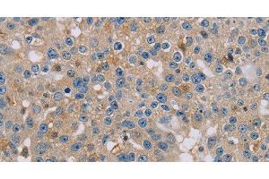 Immunohistochemistry of paraffin-embedded Human breast cancer using CLIC1 Polyclonal Antibody at dilution of 1:30 (CLIC1 anticorps)