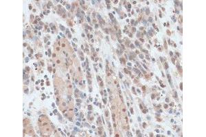 Immunohistochemistry of paraffin-embedded Human gastric cancer using ZNF562 Polyclonal Antibody at dilution of 1:100 (40x lens). (ZNF562 anticorps)