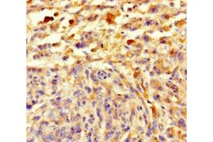 Immunohistochemistry of paraffin-embedded human melanoma using ABIN7148108 at dilution of 1:100 (C12ORF68 anticorps  (AA 1-194))
