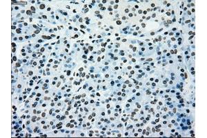Immunohistochemical staining of paraffin-embedded Adenocarcinoma of colon tissue using anti-SILV mouse monoclonal antibody. (Melanoma gp100 anticorps)