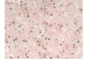 Detection of IL4 in Human Glioma Tissue using Polyclonal Antibody to Interleukin 4 (IL4) (IL-4 anticorps  (AA 25-153))