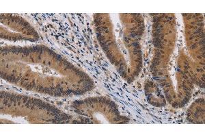 Immunohistochemistry of paraffin-embedded Human colon cancer using KCNG4 Polyclonal Antibody at dilution of 1:40 (KCNG4 anticorps)