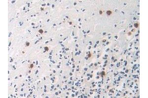 Detection of DOK3 in Human Colorectal cancer Tissue using Polyclonal Antibody to Docking Protein 3 (DOK3)