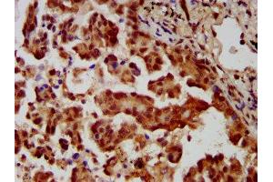 IHC image of ABIN7159000 diluted at 1:400 and staining in paraffin-embedded human lung cancer performed on a Leica BondTM system. (MBIP anticorps  (AA 91-241))