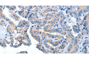 Immunohistochemistry of paraffin-embedded Human thyroid cancer using AMDHD2 Polyclonal Antibody at dilution of 1:40 (AMDHD2 anticorps)