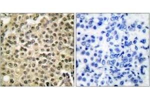 Immunohistochemistry analysis of paraffin-embedded human breast carcinoma tissue, using RAN Antibody.