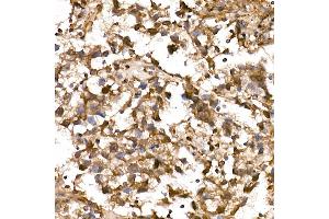 Immunohistochemistry of paraffin-embedded Human testicular seminoma using NY-ESO-1 Rabbit pAb (ABIN6131864, ABIN6143238, ABIN6143239 and ABIN6221674) at dilution of 1:200 (40x lens).