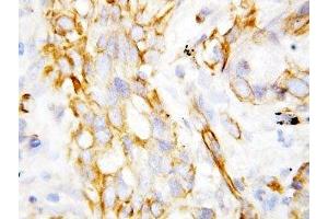IHC-P: beta Defensin 1 antibody testing of lung cancer tissue (beta Defensin 1 anticorps  (C-Term))