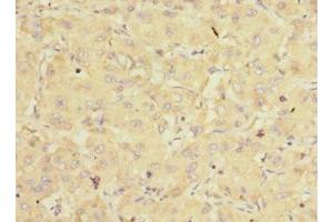 Immunohistochemistry of paraffin-embedded human liver cancer using ABIN7152170 at dilution of 1:100 (EIF3K anticorps  (AA 1-218))