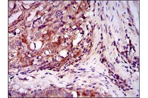 Immunohistochemical analysis of paraffin-embedded esophageal cancer tissues using ILK mouse mAb with DAB staining. (ILK anticorps  (AA 97-244))