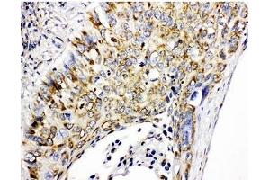 IHC-P: Prohibitin antibody testing of human lung cancer tissue (Prohibitin anticorps  (C-Term))