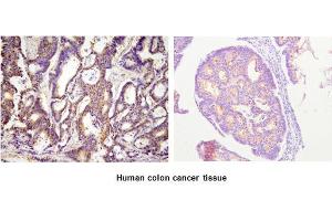 Paraffin embedded sections of human colon cancer tissue were incubated with anti-human ACOT11 (1:100) for 2 hours at room temperature. (ACOT11 anticorps  (AA 19-250))