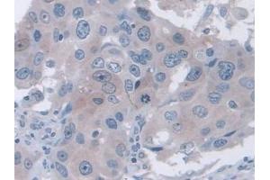 IHC-P analysis of Human Breast cancer Tissue, with DAB staining. (FAM3B anticorps  (AA 30-187))