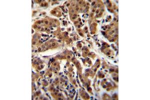 AKT1 Antibody (C-term ) (ABIN655915 and ABIN2845314) immunohistochemistry analysis in formalin fixed and paraffin embedded human breast carcinoma followed by peroxidase conjugation of the secondary antibody and DAB staining.