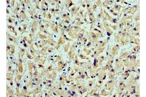 Immunohistochemistry of paraffin-embedded human liver cancer using ABIN7149003 at dilution of 1:100 (CST7 anticorps  (AA 20-145))