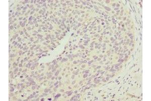 Immunohistochemistry of paraffin-embedded human cervical cancer using ABIN7147492 at dilution of 1:100 (CCM2 anticorps  (AA 1-300))