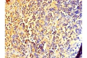 Immunohistochemistry of paraffin-embedded human bladder cancer using ABIN7150017 at dilution of 1:100 (DIS3L2 anticorps  (AA 201-400))