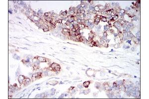 Immunohistochemical analysis of paraffin-embedded ovarian cancer tissues using CK5 mouse mAb with DAB staining. (IGFBP7 anticorps  (AA 52-156))