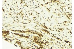 ABIN6269171 at 1/100 staining Human breast cancer tissue by IHC-P. (JunD anticorps)