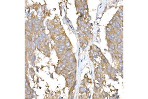 Immunohistochemistry of paraffin-embedded human lung cancer using USO1 Rabbit mAb (ABIN7271234) at dilution of 1:25 (40x lens). (USO1 anticorps)
