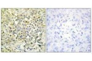 Immunohistochemistry analysis of paraffin-embedded human lung carcinoma tissue using CDKL4 antibody. (CDKL4 anticorps  (C-Term))