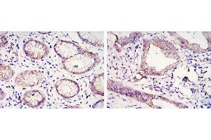 Immunohistochemical analysis of paraffin-embedded gastric cancer tissues (left) and lung cancer tissues (right) using CDH1 antibody with DAB staining. (E-cadherin anticorps)