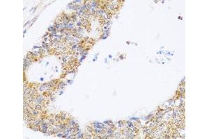 Immunohistochemistry of paraffin-embedded Human colon carcinoma using ZAK Polyclonal Antibody at dilution of 1:100 (40x lens). (ZAK anticorps)