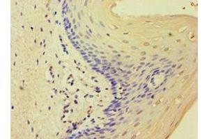 Immunohistochemistry of paraffin-embedded human cervical cancer using ABIN7159821 at dilution of 1:100