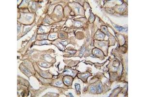 IHC analysis of FFPE human lung carcinoma tissue stained with HRAS antibody