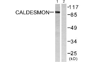 Immunohistochemistry analysis of paraffin-embedded human breast carcinoma tissue using Caldesmon (Ab-789) antibody. (Caldesmon anticorps  (Ser789))