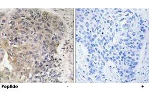 Immunohistochemistry analysis of paraffin-embedded human lung carcinoma tissue using AGBL3 polyclonal antibody . (AGBL3 anticorps)