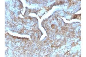 Formalin-fixed, paraffin-embedded human Prostate Carcinoma stained with Thymidine Phosphorylase Rabbit Recombinant Monoclonal (TYMP/2890R).