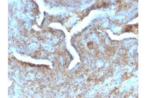 Formalin-fixed, paraffin-embedded human Prostate Carcinoma stained with Thymidine Phosphorylase Rabbit Recombinant Monoclonal (TYMP/2890R). (Recombinant Thymidine Phosphorylase anticorps)