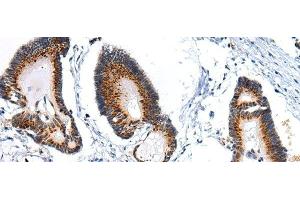 Immunohistochemistry of paraffin-embedded Human colorectal cancer using ARFGAP2 Polyclonal Antibody at dilution of 1/25 (arfgap2 anticorps)