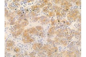 ABIN6263207 and ABIN6277295 at 1/100 staining human thymoma by IHC-P. (MEF2C anticorps  (C-Term))