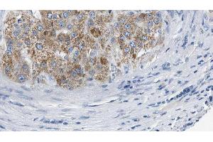 ABIN6274572 at 1/100 staining Human liver cancer tissue by IHC-P. (Serotonin Receptor 2B anticorps  (Internal Region))