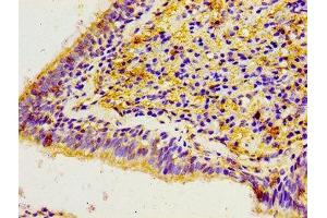 Immunohistochemistry of paraffin-embedded human lung cancer using ABIN7146450 at dilution of 1:100 (CACYBP anticorps  (AA 2-228))