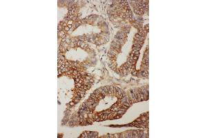 Anti- BCL2L2 antibody, IHC(P) IHC(P): Human Rectal Cancer Tissue (BCL2L2 anticorps  (Middle Region))
