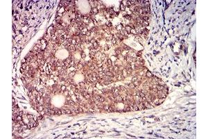 Immunohistochemical analysis of paraffin-embedded cervical cancer tissues using CD130 mouse mAb with DAB staining.