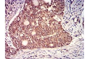 Immunohistochemical analysis of paraffin-embedded cervical cancer tissues using CD130 mouse mAb with DAB staining. (CD130/gp130 anticorps  (AA 73-231))