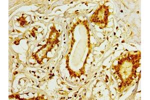 IHC image of ABIN7159833 diluted at 1:100 and staining in paraffin-embedded human breast cancer performed on a Leica BondTM system.