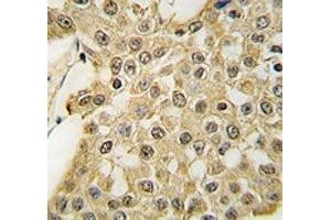 IHC analysis of FFPE human breast carcinoma tissue stained with the MDM2 antibody