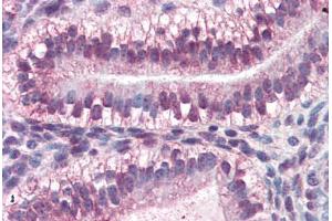 Human Uterus (formalin-fixed, paraffin-embedded) stained with CRABP2 antibody ABIN364443 at 10 ug/ml followed by biotinylated anti-mouse IgG secondary antibody ABIN481714, alkaline phosphatase-streptavidin and chromogen. (CRABP2 anticorps  (AA 1-138))