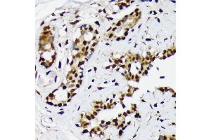 Immunohistochemistry of paraffin-embedded human breast cancer using ILF2 Rabbit mAb (ABIN7268007) at dilution of 1:100 (40x lens). (ILF2 anticorps)