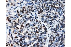 Immunohistochemical staining of paraffin-embedded Adenocarcinoma of breast tissue using anti-RALBP1 mouse monoclonal antibody. (RALBP1 anticorps)