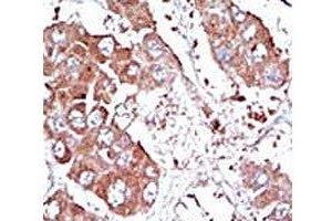 IHC analysis of FFPE human hepatocarcinoma tissue stained with the ALK3 antibody