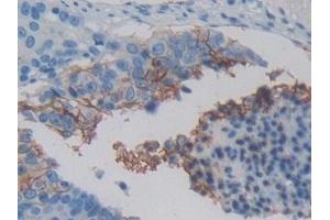 Detection of MET in Human Lung cancer Tissue using Polyclonal Antibody to C-Met (MET)