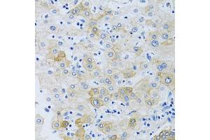 Immunohistochemistry of paraffin-embedded human liver using SLC4 antibody (ABIN6132890, ABIN6148015, ABIN6148016 and ABIN6214688) at dilution of 1:100 (40x lens). (NBC4 anticorps  (AA 1042-1121))