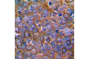 Immunohistochemical analysis of MKK1 staining in human prostate cancer formalin fixed paraffin embedded tissue section. (MEK1 anticorps  (Center))